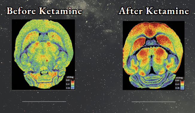 Depression and anxiety relief brain scan